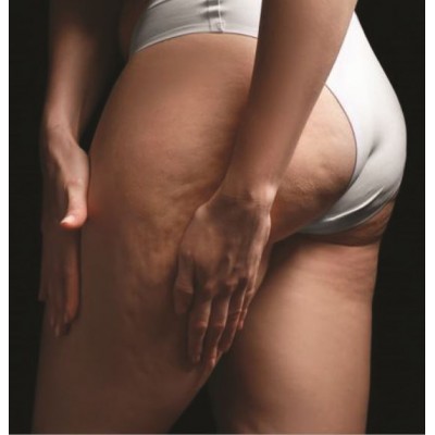 Ritenzione Idrica & Cellulite